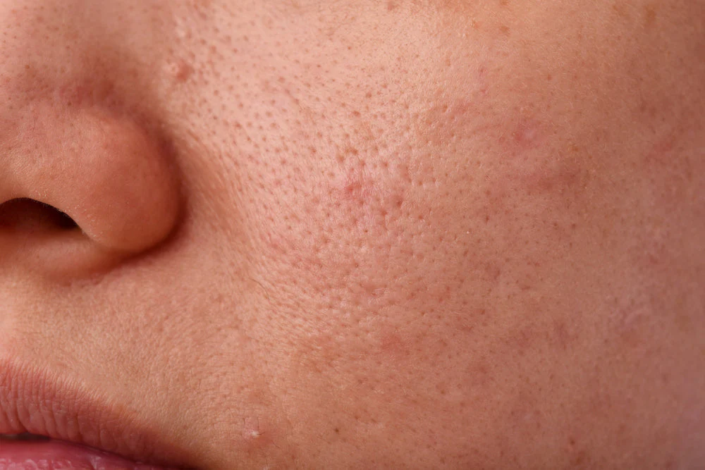 Helps Prevent Acne and Clogged Pores