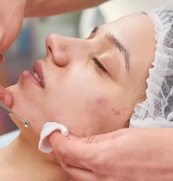 Acne Treatment Facial